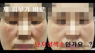 피부 하얘지는 법? I 제대로 알고 레이저 받으세요! I 기미치료 잘하는곳