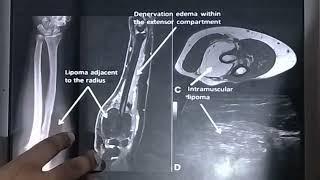 MRI NEUROGRAPHY, NEUROGRAPHY SEQUENCE