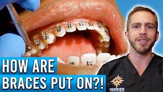 How Are Braces Put On?