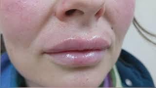 Lip filler / augmentation at Skinox Aesthetics