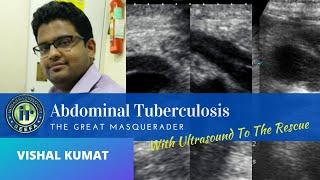 ABDOMINAL KOCHS - THE GREAT MASQUERADER  | VISHAL KUMAT | ABDOMINAL ULTRASOUND | MESENTERIC NODES