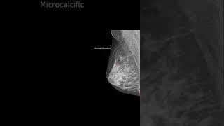 3.Ductal Carcinoma In Situ Of Breast Mammography@#@#Awerenes of All.Breast Cancer@#@#Breast disease#