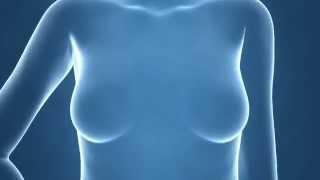 Breast Cancer Therapy - Medical Animation by Watermark