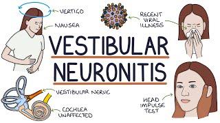 Understanding Vestibular Neuronitis