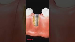 Установка имплантата на месте удаленного зуба #vatech #стоматология #зубы #рентген #software