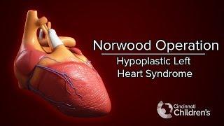 Medical Animation: Norwood Operation | Cincinnati Children's