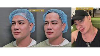 Angled Jawline and chin elongation | Dr. Contessa Salvador