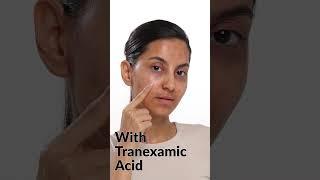 Spot Treatment for Pigmentation & Melasma