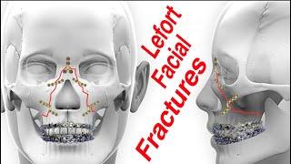 Lefort 1-3 Upper Jaw (Mid-Face) Facial Fractures