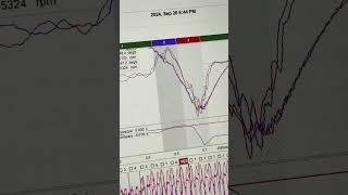 Comparing top two laps - Reviewing gokart race data with RaceStudio 3 and MyChron