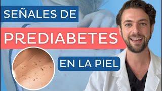 La PIEL muestra SEÑALES de PREDIABETES ‼️