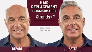 The Secret to looking Younger with Hair Replacement