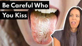 Can You Get A Yeast Infection In Your Mouth?! (White Tongue, Oral Thrush)