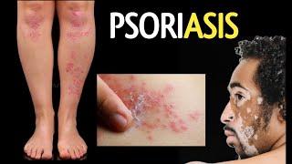 Psoriasis types symptoms causes || सोरायसिस क्या है क्यों होता है कारण लक्षण प्रकार || सोरायसिस