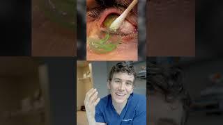 Removing 23 Contact Lenses Stuck in Eye Reaction