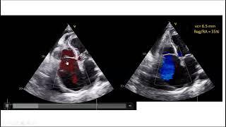 echo conference 26-6-2024, endomyocardial fibrosis