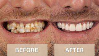 Before & After Smile Makeover Transformations | Dental Boutique™