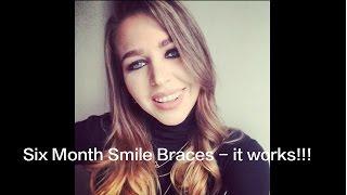 Six Month Smiles braces | Review |(my story) Your Questions answered