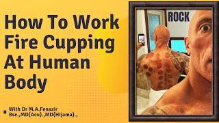 Why Everyone Should Try Fire Cupping | Alshifa Cupping Clinic