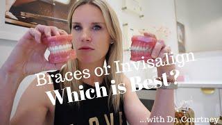 BRACES OR INVISALIGN CLEAR ALIGNERS? 2024 | Which is better?