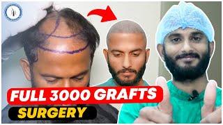 Hair Transplant in Ahmedabad | Cost of Hair Transplant in Gujarat | Grade 4 Baldness | 3000 Grafts