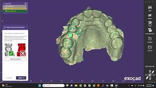 EXOCAD: Single Implant Crown