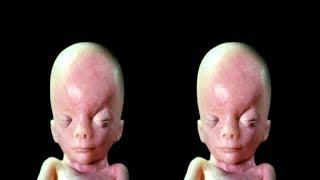 In the Womb - Identical Twins