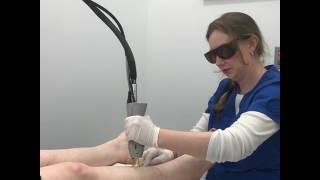 Laser Hair Removal at Blue Water Spa