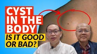 Cysts in the Body, Is It Good or Bad?