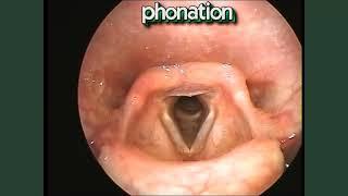 Vocal Cord Movements