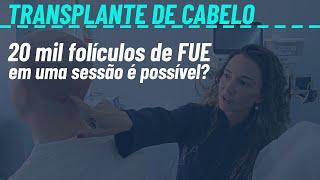 FUE com 20 mil folículos é possível?