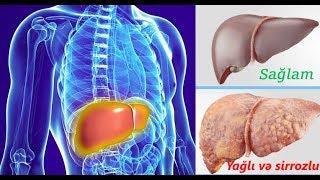 Qastroenteroloq,Endoskopist Dr. Emin Mammadov | Qaraciyər yağlanması-Steatoz-Hepatit (NASH/NAFLD)