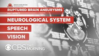 Brain aneurysms "can happen at any age," doctor says