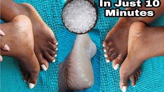 HOW TO REMOVE DEAD SKIN FROM YOUR FEET NATURALLY AT HOME 2021| CRACKED HEELS HOME REMEDY