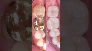 Here’s a behind-the-scenes look from a full-mouth reconstruction with a biomimetic approach #dentist