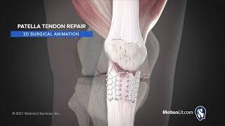 3D Surgical Procedure Depicts Complex Patella Tendon Repair