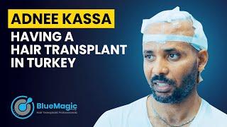 BlueMagic Group International | Adnee Kassa having a Hair Transplant in Turkey