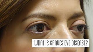 What is Graves' Eye Disease?