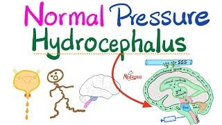 Normal Pressure Hydrocephalus (NPH) - Urinary Incontinence, Ataxia, Dementia (memory loss) - Neuro