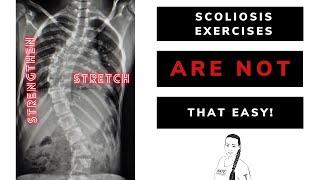 The truth about scoliosis exercises: what others won't tell You