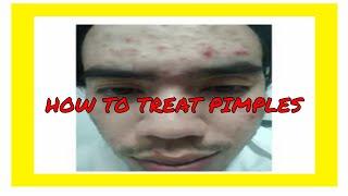 PAANO NAWALA ANG PIMPLES|How to Treat Pimples|Doc  Avonasac