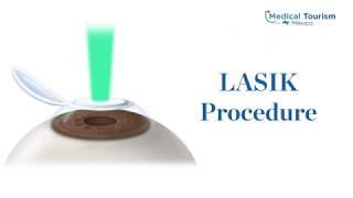 LASIK procedure - Medical Tourism Mexico