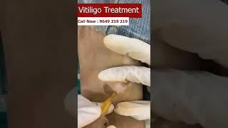 Vitiligo treatment at skinaa clinic #shorts #vitiligo_treatment #White_Spots_Removal #skinaaclinic