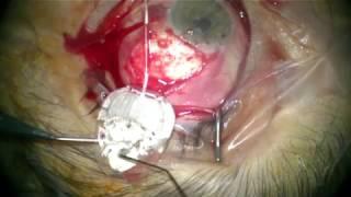 AHMED GLAUCOMA VALVE - Prof Dr Volkan DAYANIR