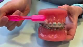 Fixed Braces Oral Hygiene instructions TLOG