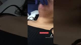 Kybella for the Double Chin