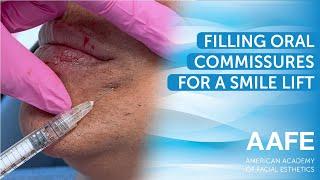 Filling Oral Commissures for a Smile Lift