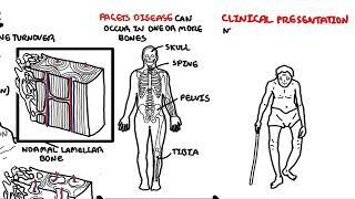 Paget's Disease of the bone