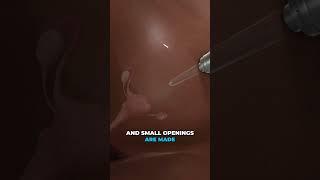 Removing fibroids from your uterus (3D Animation)