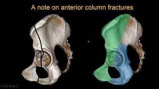 imaging Acetabular fracture